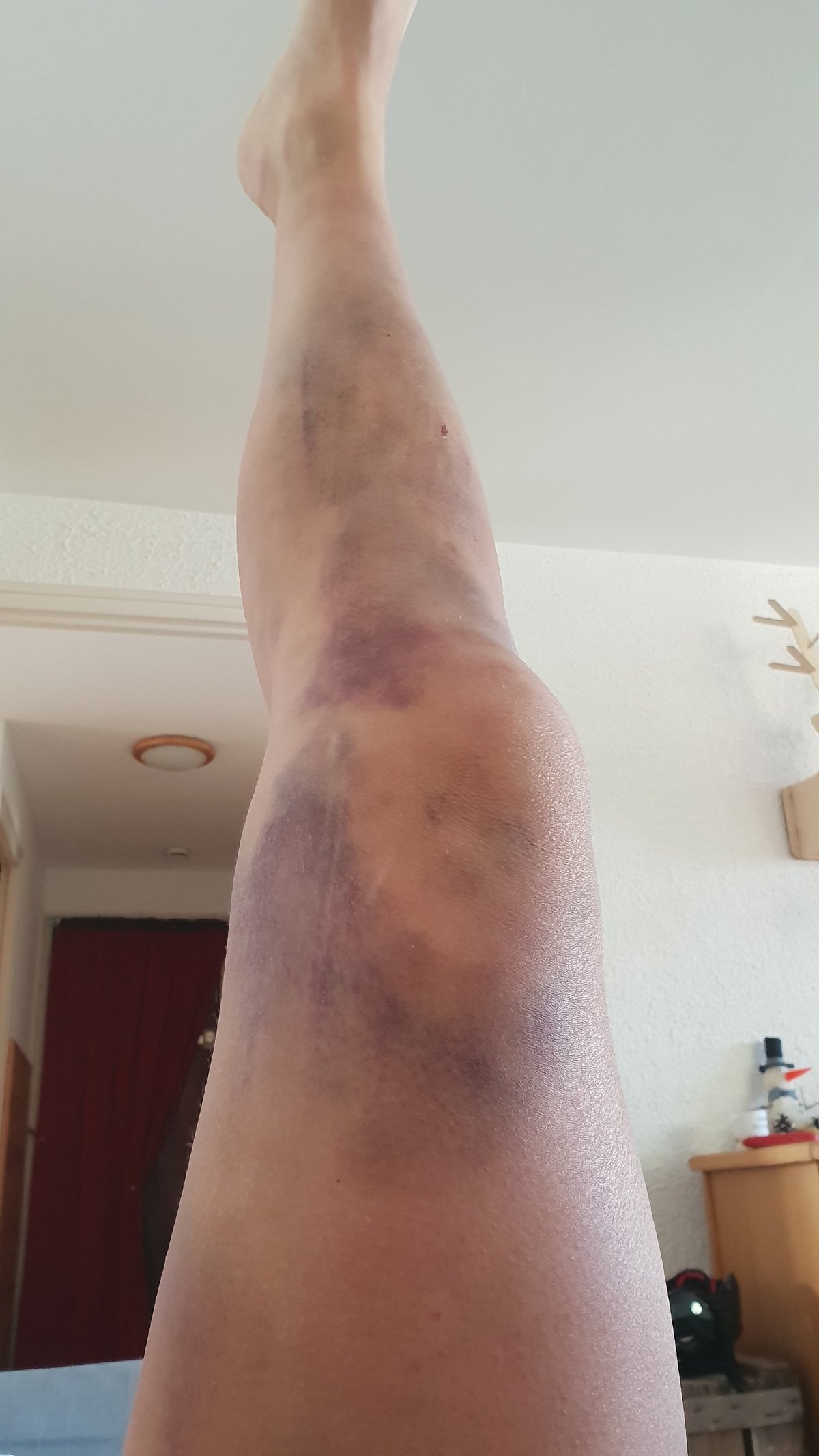 Mein Bein nach dem Sturz am Donnerstag schaut etwas mitgenommen aus, zum Glück nur ein Riesen-Bluterguss. Aber schmerzen tut es trotzdem … Mein Bein nach dem Sturz am Donnerstag schaut etwas mitgenommen aus, zum Glück nur ein Riesen-Bluterguss. Aber schmerzen tut es trotzdem …