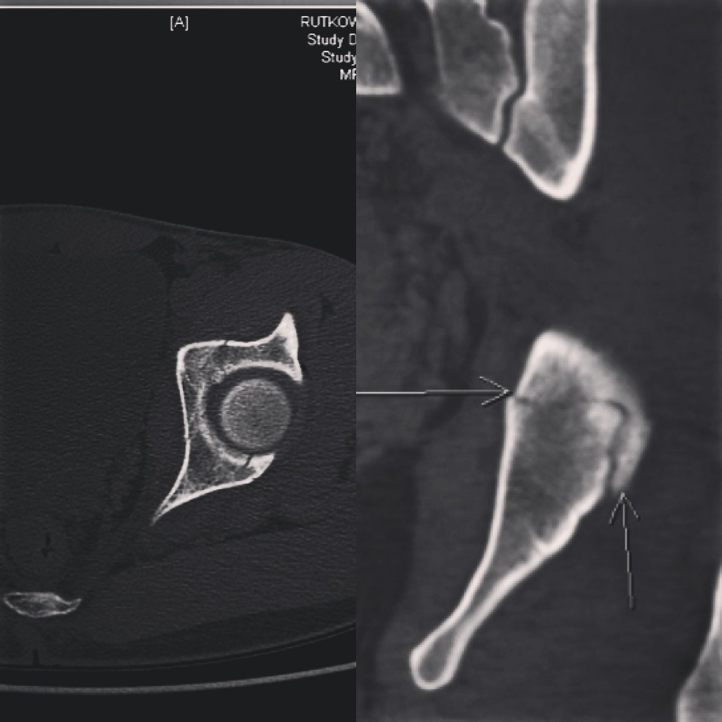 Foto: Acetabulum Fraktur - MTB-News.de