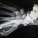 hope-hand-xray