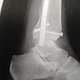 Gebrochene Fibula und Tibia ...