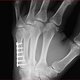 Hand 2